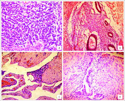 Foco na endometriose on instagram: Laminas Mostrando Padrao Histologico Dos Diversos Tipos De Download Scientific Diagram