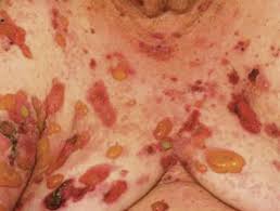 Bullous Pemphigoid Images Dermnet Nz The blisters are usually located on the arms, legs, or middle of the body. bullous pemphigoid images dermnet nz