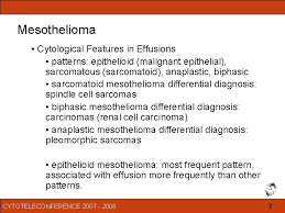 Sarcomatoid mesothelioma is primarily diagnosed by a tissue biopsy. Malignant Mesothelioma In Effusions And Fine Needle Aspirates