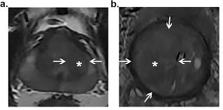Use the menu below to choose the introduction section to get started. Cureus Classification Of Prostate Transitional Zone Cancer And Hyperplasia Using Deep Transfer Learning From Disease Related Images