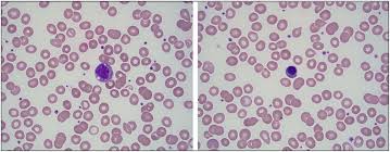 Trapani s, micheli a, grisolia f, resti m, chiappini e, falcini f, et al. Frontiers Henoch Schonlein Purpura Presenting In Association With Neuroblastoma A Case Report Pediatrics