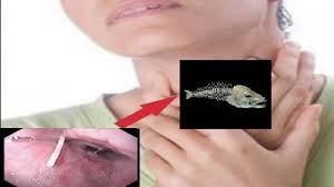 Bila makan ikan, risiko nak tercekik tulang tinggi kecuali makan isi ikan. Jangan Remehkan Tertelan Duri Ikan Bisa Sebabkan Abses Retrofaringeal Dan Infeksi Watyutink