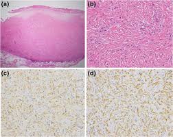desmoplastic melanoma is a relatively rare variant of malignant melanoma with an estimated incidence of 2.0 per 1 000 000 individuals. Malignant Mesothelioma Of The Pleura With Desmoplastic Histology A Case Series And Literature Review Bmc Cancer Full Text