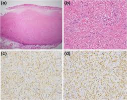 Because the cells form in separate nodules when determining what type of mesothelioma a patient has, physicians will use histology, the study. Malignant Mesothelioma Of The Pleura With Desmoplastic Histology A Case Series And Literature Review Bmc Cancer Full Text