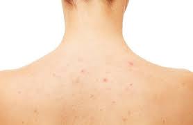 What are the best acne scar treatments? Easy And Effective Home Remedies To Treat Back Acne Scars