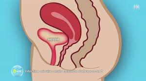 Une infection urinaire (ou infection des voies urinaires ou ivu) est définie par la colonisation des urines par des bactéries, ce qui se traduit le plus souvent par des signes infectieux urinaires. E M6 Dimanche 3 Mars 2019 Page 11 Sur 12