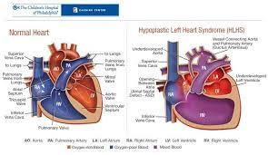 Hypoplastic Left Heart Syndrome Hlhs Hlhs Is Exactly What It Sounds Like The Left Pediatric Heart Congenital Heart Defect Congenital Heart Defect Awareness