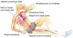 What Is Shock In First Aid First Aid For Free
