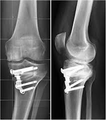 Ramindo daya perkasa membuka lowongan kerja di kota medan dengan posisi berikut ini: Medial Unicompartmental Knee Arthroplasty After Failed Open Wedge High Tibial Osteotomy The Journal Of Arthroplasty