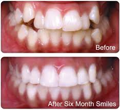 How To Treat Crooked Teeth Fast 4 Ways With Video Crooked Teeth Cosmetic Braces Clear Braces