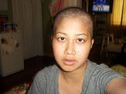 Stopped tx after 8 months because i thought it wasn't working and my tremors were becoming a nuisance. Living With Lupus Elizatran86 S Blog