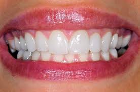 Porcelain Veneers And Receding Gums Nashville Tn