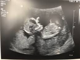 What Is Considered Big Subchorionic Hematoma Forums