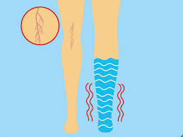 Se especula que tuvieron que amputarle una pierna. Cuales Son Los Sintomas De Una Trombosis Venosa Profunda Enfermedades