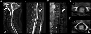 G37.3 acute transverse myelitis in demyelinating disease of central nervous system g37.4 subacute necrotizing myelitis of central nervous system g37.5 concentric sclerosis balo of central nervous system g37.8 other specified demyelinating diseases of central nervous system g37.9 demyelinating disease of central nervous system, unspecified A Case Of Longitudinally Extensive Transverse Myelitis With An Isolated Pontine Lesion Following Epidural And Spinal Anesthesia For Cesarean Section Sciencedirect