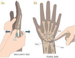 A traumatic tear may injure the tfcc ligaments or the cartilaginous disc, and may a degenerative (type 2) tear is a more chronic or degenerative injury. Aspetar Sports Medicine Journal Injuries To The Triangular Fibrocartilage Complex Tfcc Of The Wrist