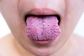 Image result for brown tongue symptoms