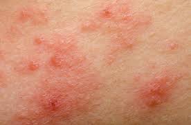Tratamento Nutricional Da Dermatite Atopica Andreia Torres