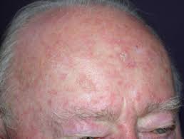 A dry, scaly lip that never heals. Actinic Keratosis Dermnet Nz