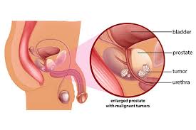 1 in 9 men will be diagnosed with prostate cancer at some point in his life. Prostate Cancer Screening Steinberg Urology Montreal