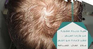 نتميز بخبرة حصرية في زراعة الشعر علاج كل مشاكل الشعر باحدث تقنيات الطب من الميزوثيرابي والبلازما الأمريكية نهتم بأدق التفاصيل وبدون اي اثار Movie Posters Movies