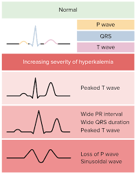 Before this you need you should inject soda in cardiac arrest in combination with hyperkalemia. Hyperkalemia Concise Medical Knowledge