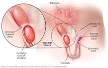 Image result for how do women know if inguinal hernia needs treatment
