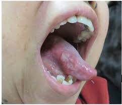 Image result for papillomavirus tongue)