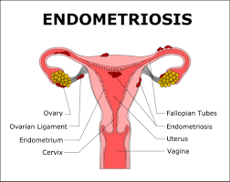 The exact incidence in the general. Kann Man Endometriose Mit Cannabis Behandeln Sensi Seeds