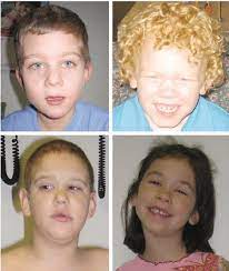 Maybe you would like to learn more about one of these? Facial Features Of Fragile X Syndrome As Illustrated By The Download Scientific Diagram