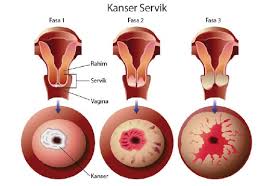 Tahukah anda ia merupakan kanser paling tinggi penyebab kerosakan organ pembiakan wanita? Kanser Serviks Boleh Sembuh Ini Caranya Bebelsihat Com