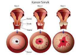 Menderita nyeri pada daerah kaki bukan berarti merupakan tanda bahwa anda pasti. Kanser Serviks Boleh Sembuh Ini Caranya Bebelsihat Com