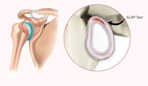 Image result for SLAP Lesion
