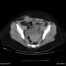 Endometriosis affects an estimated 176 million women worldwide regardless of their ethnic and many remain undiagnosed and are therefore not treated. Abdominal Wall Endometriosis Radiology Case Radiopaedia Org