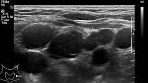 A ct scan takes pictures of the inside of because cancer tends to use energy actively, it absorbs more of the radioactive substance. Lymphoma Action Ultrasound And X Ray Scans