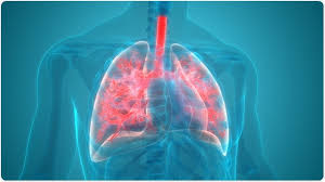 Image result for Pneumonia