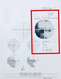 緑内障の進行度を測る数値【MD値】に注目 | 明眸はり治療室