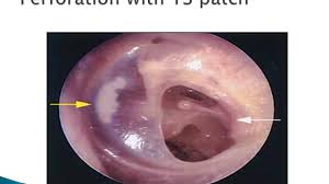 Chronic suppurative otitis media (csom) is one of the leading causes of preventable disabling hearing impairment (dhi) in developing countries. Chronic Suppurative Otitis Media Tubo Tympanic Ent Lecture Series Youtube