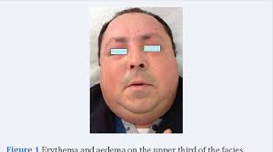 Jacques nougier, ker 12 : Pdf Morbihan S Syndrome Report Of A Case And Literature Review Semantic Scholar
