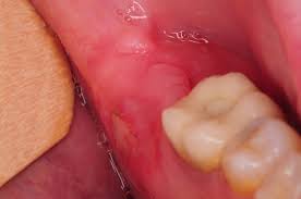 Sore Exposed Bone Following Wisdom Teeth Extractions Sore Exposed Bone Following Wisdom Teeth Extractions Kazemi Oral Surgery Facialart Com