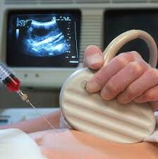 Image result for Chorionic Villus Sampling