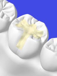 A cavity that is left untreated can grow larger and cause additional damage to your tooth. Do Fillings Need To Be Replaced Here S What You Need To Know