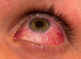 7 Natural And Easy Home Remedies For Red Eyes