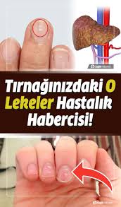 Tirnaktaki Beyaz Lekeler Neden Olur Hangi Hastaligin Habercisidir Nasil Tedavi Edilir Saglik Dogal Saglik Saglik Urunleri