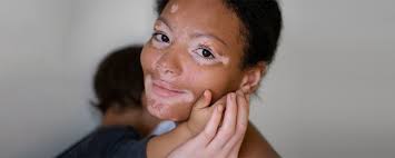 Image result for Vitiligo