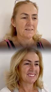 A querida paciente Isa realizou seu sonho de voltar a sorrir! 😁 Com a  prótese do tipo protocolo, ela recuperou a confiança ao mastigar e falar,  melhorou sua autoestima e transformou sua vida para ...