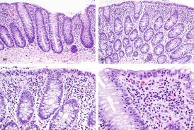 Image result for Microscopic Colitis