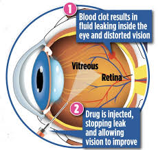 Maybe you would like to learn more about one of these? A Poke In The Eye Can Save Your Sight Blindness Caused By Blood Clots Can Now Be Cured By A Simple Jab Daily Mail Online
