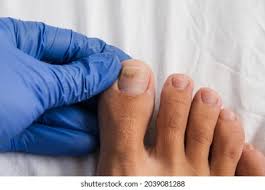 Image result for Onycholysis feet