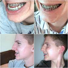 • • • does lacoms do revision cases? 5 Weeks After Double Jaw Surgery Before And After Braces